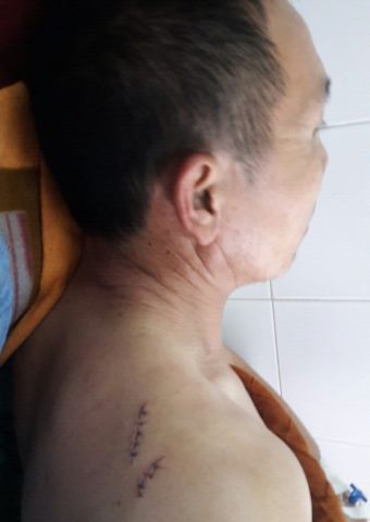 A close up of one of Brother Nou's injuries.