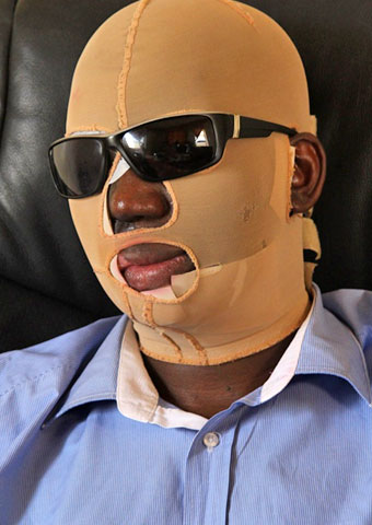 Pastor Umar Mulinde is still undergoing treatment and must wear a specialized bandage for severe burns in a Christmas Eve 2011 acid attack by radical Muslims in Uganda.