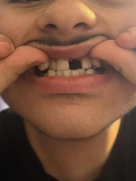 The young man had a front tooth smashed and replaced with a partial denture.