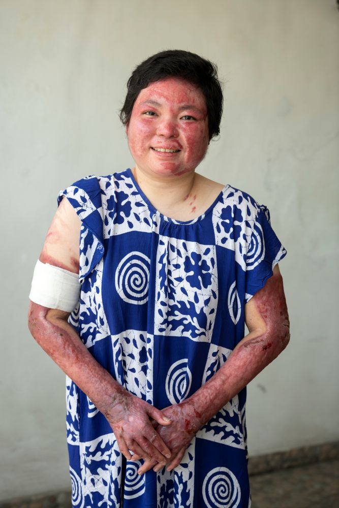 Fenny underwent many procedures to regain use of her arms and hands.