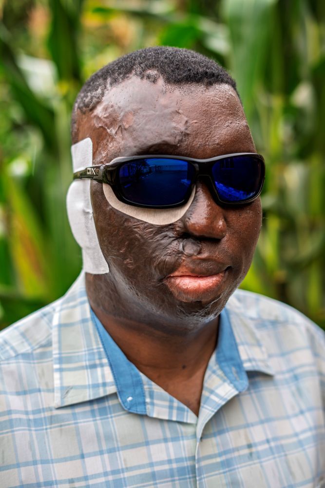 Pastor Umar Mulinde after his surgery.