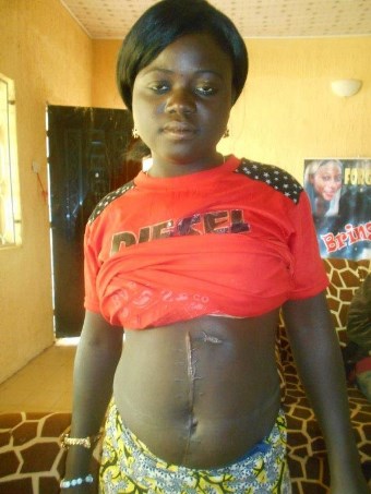 Juliana David from Nigeria shows her surgery scar after being shot in the back by Fulani Muslim gunmen.