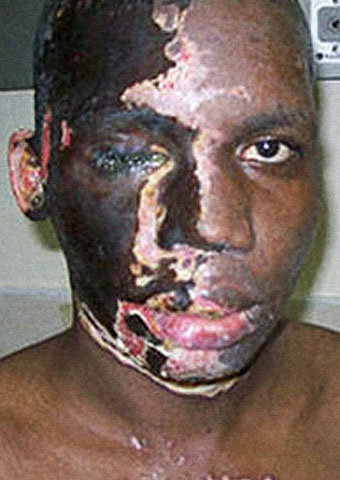 After surviving an attack by radicals who poured acid on his face and back, Pastor Umar Mulinde is returning to his family and church home in Uganda.